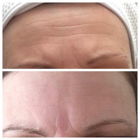 PureFirme non-invasive wrinkle reduction - Beaux Health & Wellbeing